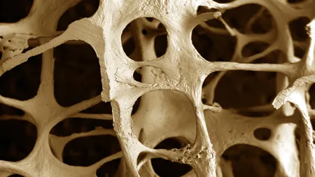Tratamente eficiente împotriva osteoporozei. Ce să mănânci pentru a evita sau ameliora boala