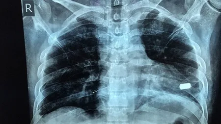 Bărbatul care a sfidat moartea: A trăit două luni cu un glonţ în inimă