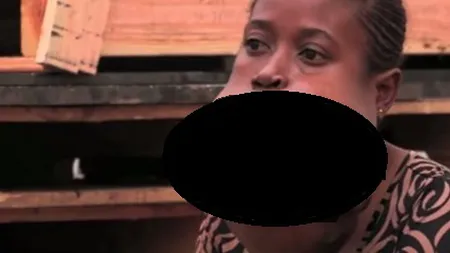 Anomalie ŞOCANTĂ. O tânără a trăit 10 ani cu o tumoră facială mare cât o minge de fotbal VIDEO