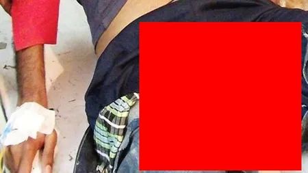A ajuns la SPITAL cu un FIER în FUND. Ce s-a întâmplat este ALARMANT şi i se poate întâmpla ORICUI FOTO