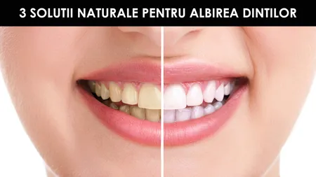 Soluţii naturale pentru albirea dinţilor