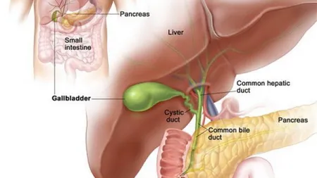 Ai pietre la fiere? Iată care este dieta recomandată bolnavului cu litiază biliară