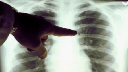 TUBERCULOZA omoară peste 1.000 ROMÂNI PE AN. Nu mai avem nici MEDICI SPECIALIZAŢI