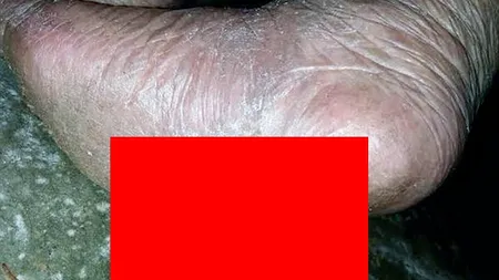 Agonie de nedescris pentru o femeie după ce i-au crescut COARNE în TALPĂ VIDEO