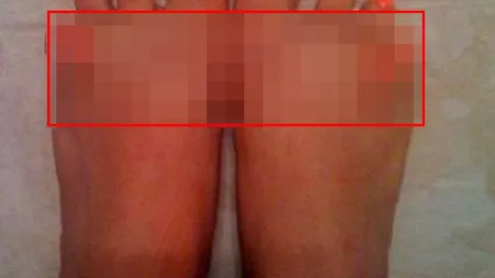S-a născut cu o MALFORMAŢIE BIZARĂ la DEGETE. Cum arată picioarele aceste femei FOTO