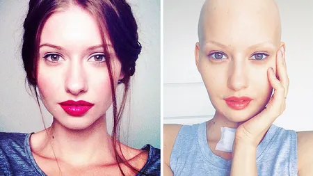 Drama unui model celebru. Are cancer la maxilar, iar doctorii au pus-o să avorteze