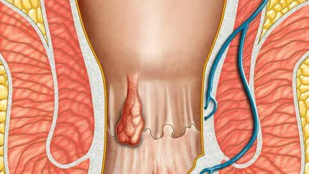 Ce sunt hemoroizii interni şi cum ştii că îi ai