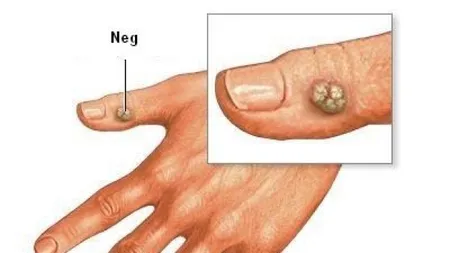 Scapă de negi cu un ingredient din bucătărie