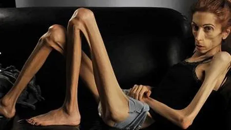Transformare dramatică. Cum arată acum femeia care cântărea doar 18 kg VIDEO