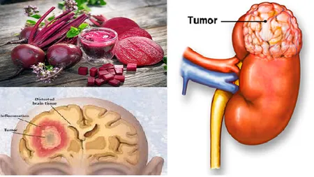 Terapia cu sfeclă roşie împotriva leucemiei şi tumorilor maligne, de 10 ori mai eficientă decât citostaticele
