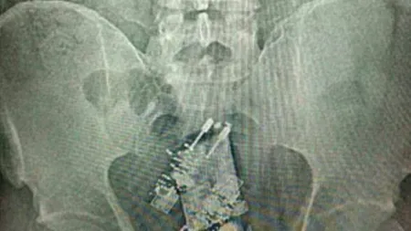 Un telefon şi două încărcătoare, descoperite în corpul unui deţinut