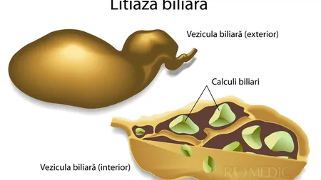 Un preparat uimitor te scapă rapid de pietrele la bila şi la rinichi