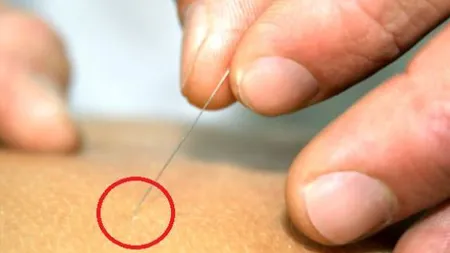 I-a salvat viaţa folosind doar un ac. Trebuie să ştii acest truc!