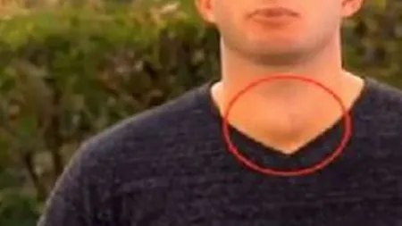Se uita la televizor, când a observat ceva bizar la gâtul prezentatorului. Gestul femeii i-a salvat viaţa tânărului