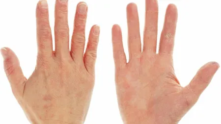 Ai mâinile aspre şi crăpate sau unghiile exfoliate? Vezi ce boli trădează aspectul mâinilor