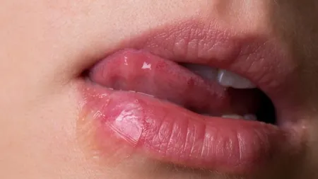 Aşa scapi de herpes, cu ce ai în casă