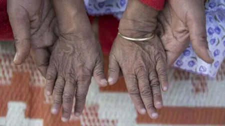 Doi copii, frate şi soră, par deja BĂTRÂNI. Pielea lor este plină de RIDURI