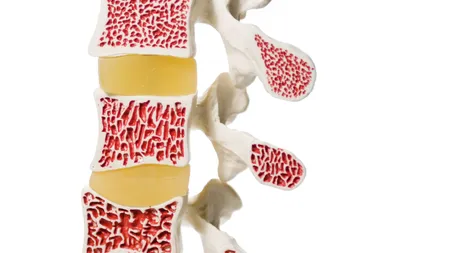 Aceste fructe previn osteoporoza