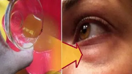 Pungile de sub ochi. 4 ponturi SPECIALE ca să scapi de ele