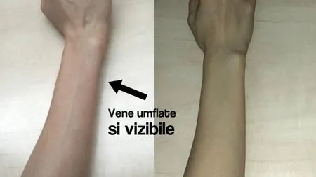 Ce înseamnă dacă ţi se văd venele