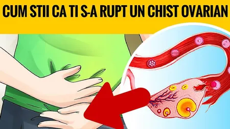 Cum îţi dai seama dacă ţi s-a rupt un chist ovarian