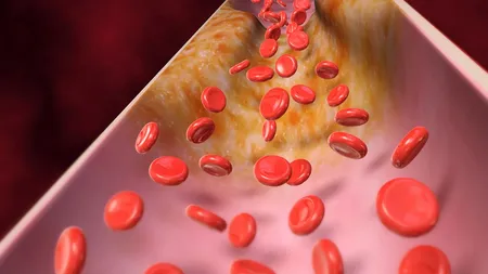 Circulaţia deficitară a sângelui poate duce la probleme grave de sănătate