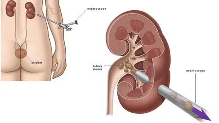 PREMIERĂ MEDICALĂ: Intervenţie laparoscopică de extirpare a unui chist renal uriaş, la Clinica de Urologie a SCJ Mureş