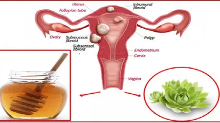 Amestecă aceste 2 ingrediente pentru a distruge chisturile şi fibroamele