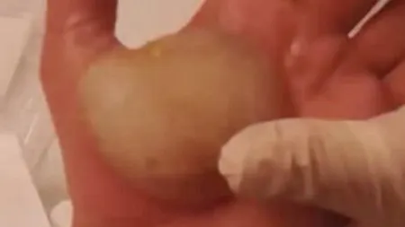 Avea o băşică imensă în palmă. A înţepat-o cu un ac, MARE GREŞEALĂ! Ce a urmat l-a îngrozit VIDEO