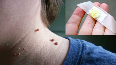 Trucul simplu care te scapă de negii mici de pe piele. Trebuie să-l încerci