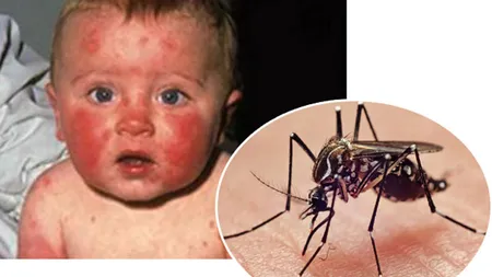 VIRUSUL ZIKA. Trei bebeluşi din SUA s-au născut cu malformaţii asociate virusului