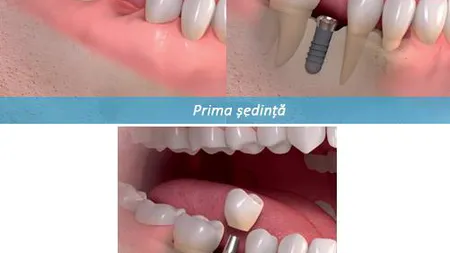 Implantul dentar într-o şedinţă, o procedură atraumatică, rapidă, cu costuri reduse