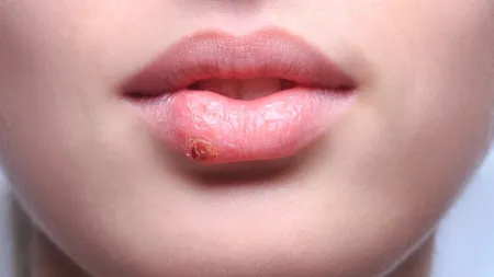 I-a ieşit un herpes şi era în PANICĂ! Aşa că şi-a dat cu ASTA şi i-a trecut - Sigur nu le ştiai!