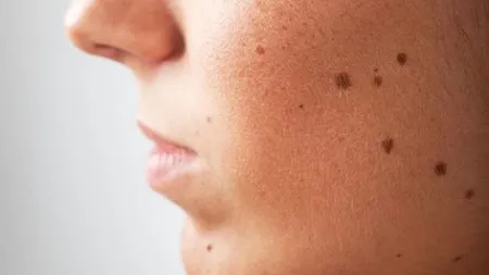 Dermatolog: O aluniţă care apare după vârsta de 30 de ani este suspectă