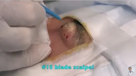 Ani de zile a stat cu o umflatură deasupra ochiului, neştiind ce are acolo. Ce se afla în interior VIDEO
