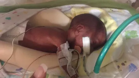 Avea numai 425 de grame la naştere, iar medicii nu i-au dat nici măcar o şansă. E un miracol ce s-a întâmplat cu copilul