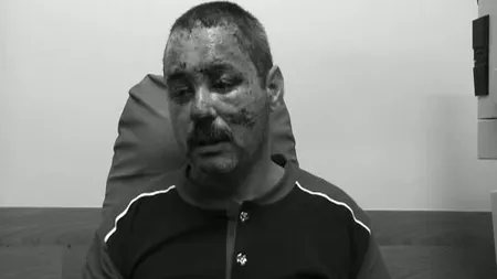 Accident grav din cauza unui capac de canal. Un şofer şi-ar putea pierde definitiv vederea VIDEO