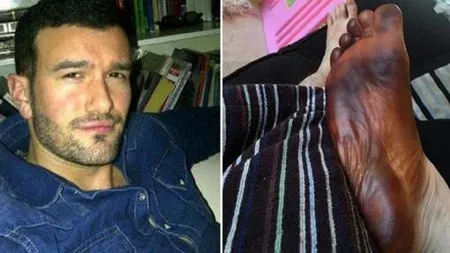 S-a trezit şi a văzut că piciorul lui se ÎNNEGRISE. Este ŞOCANT ce s-a întâmplat