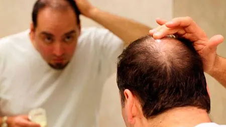 Începi să cheleşti? Iată 4 paşi să depăşeşti acest moment trist din viaţa unui barbat