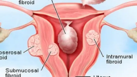 Ce simptome are fibromul uterin şi cum poate fi eliminat în jumătate de oră