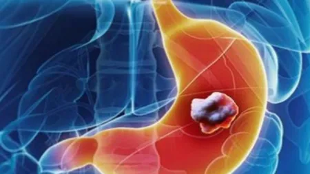 ALIMENTUL nebănuit care poate ÎNCETINI dezvoltarea CANCERULUI DE STOMAC