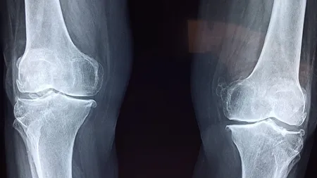 Amestecul minune care regenerează încheieturile