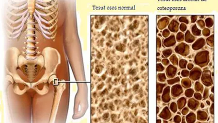 OSTEOPOROZA şi efectele ei. 5 remedii naturiste pentru combaterea acestei afecţiuni