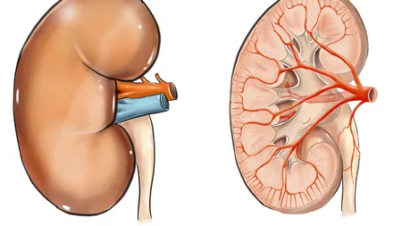 Simptomele cancerului renal