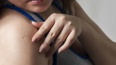 De la ce provine cicatricea rotundă pe care mulţi oameni o au pe braţul stâng