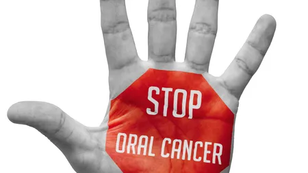 Peste 500 de cazuri de cancer oral sunt descoperite anual de medici, 60 la sută fiind neoperabile