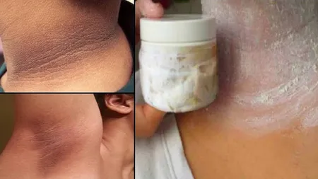 Îndepărtează zonele închise la culoare de pe gât de la axilă şi din zona inghinală în mai puţin de 15 minute!