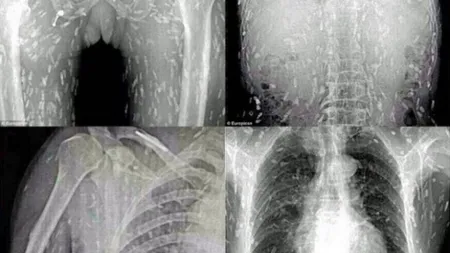 Medicii au avut un ŞOC când s-au uitat pe RADIOGRAFII. Erau vii şi peste tot VIDEO