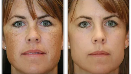 Elimină petele maro de pe faţă într-o săptămână. Tratamentul cosmetic te costă doar 3 lei