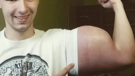Şi-a injectat o substanţă pentru a avea bicepşi de 60 de cm. Ce i s-a întâmplat este şocant VIDEO